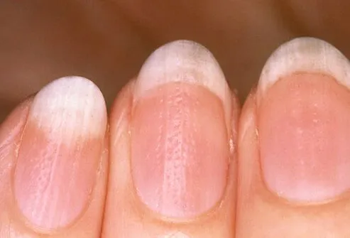 معلومات مهمة عن اظافرك نسومتى Nail_say_health_s6_pitted_nails