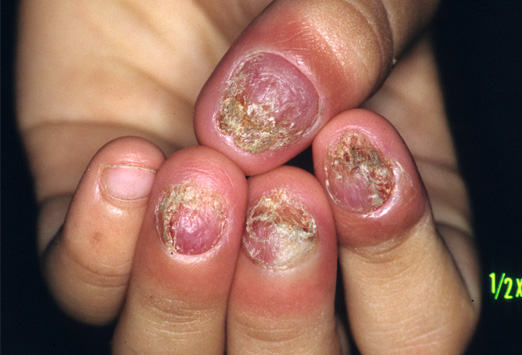 Medscape's Slideshows Top 10 for 2010 - Diseases of the Nails! Fig1