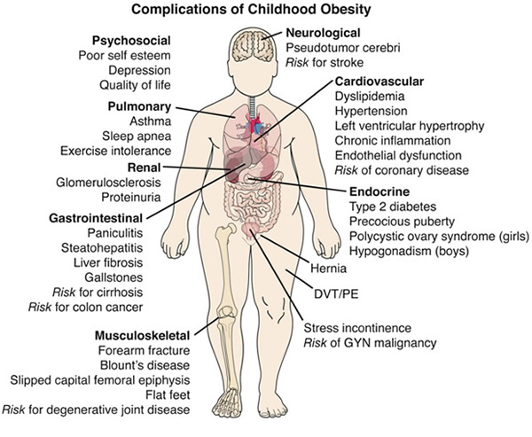 Goooogle Image Game! - Page 4 Complication-childhood-obesity