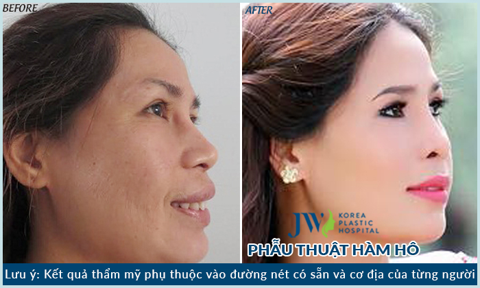 Thẩm mỹ cười hở lợi như thế nào? Ham-ho-3