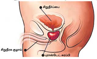 சொட்டு சொட்டாக சிறுநீர் வெளியேறுகிறதா? கவனியுங்கள்! E_1316308498