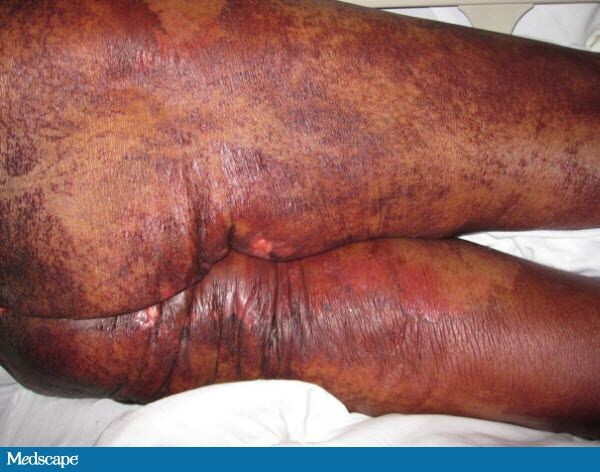 Dermatitis, Diarrhea and Alopecia: What Is Your Diagnosis? 742325-Figure-2