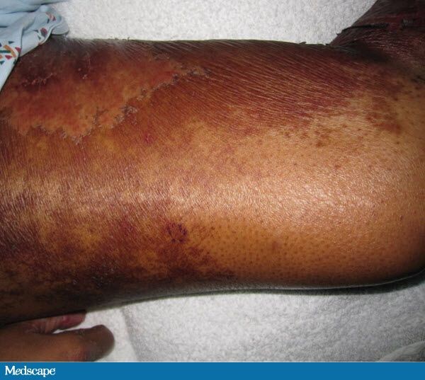 Dermatitis, Diarrhea and Alopecia: What Is Your Diagnosis? 742325-Figure-3