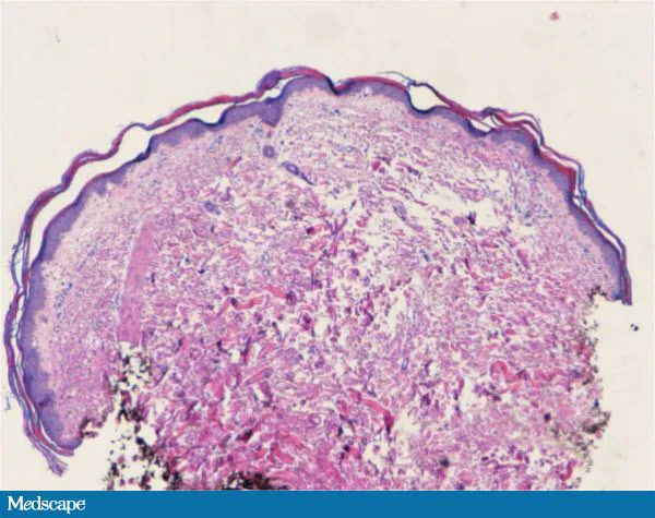 Dermatitis, Diarrhea and Alopecia: What Is Your Diagnosis? 742325-Figure-6