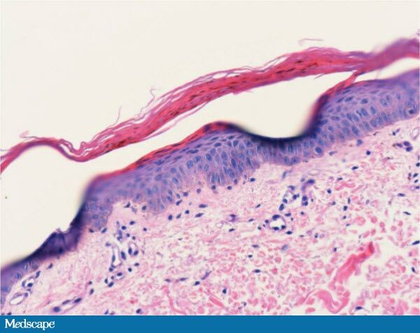 Dermatitis, Diarrhea and Alopecia: What Is Your Diagnosis? 742325-Figure-7