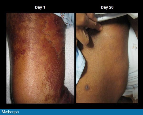 Dermatitis, Diarrhea and Alopecia: What Is Your Diagnosis? 742325-Figure-8