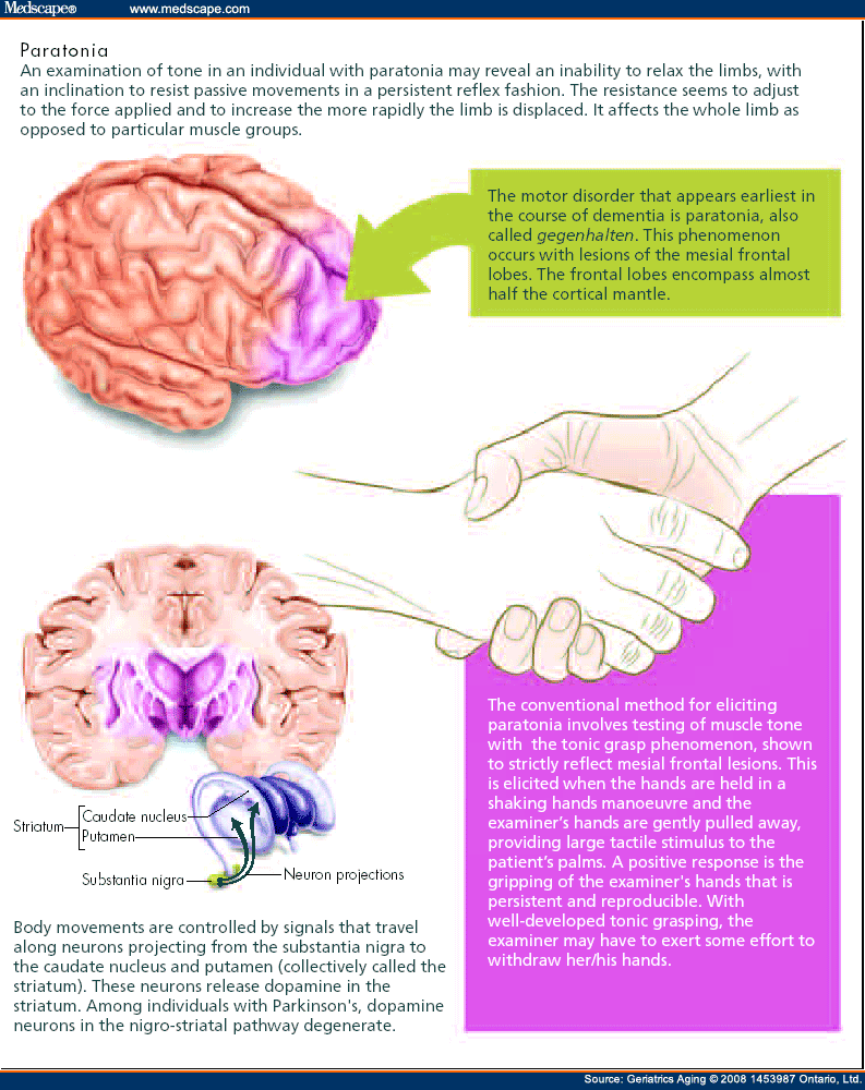 Find a brain disorder through a simple hand shake! Ga579827.fig1