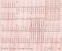 Atrial Fibrillation  150072-1332317-151066-151181tn