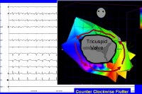 Atrial Flutter  150072-1332317-151210-1425810tn