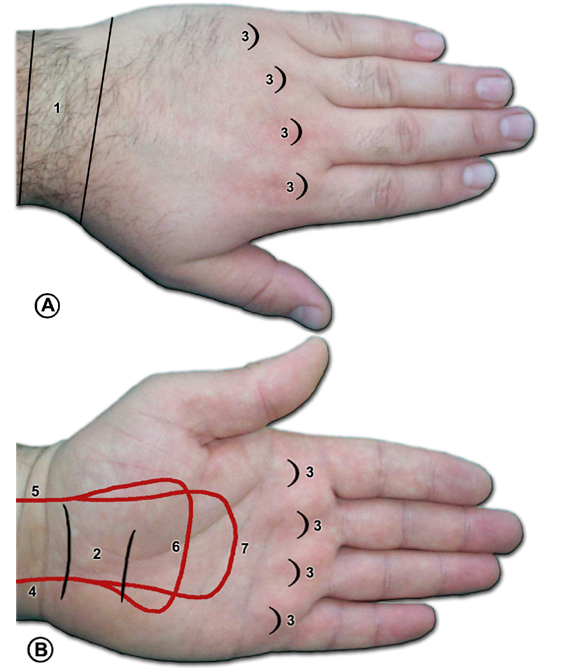 hand and arm scars of LHO 1271089-1285060-1631