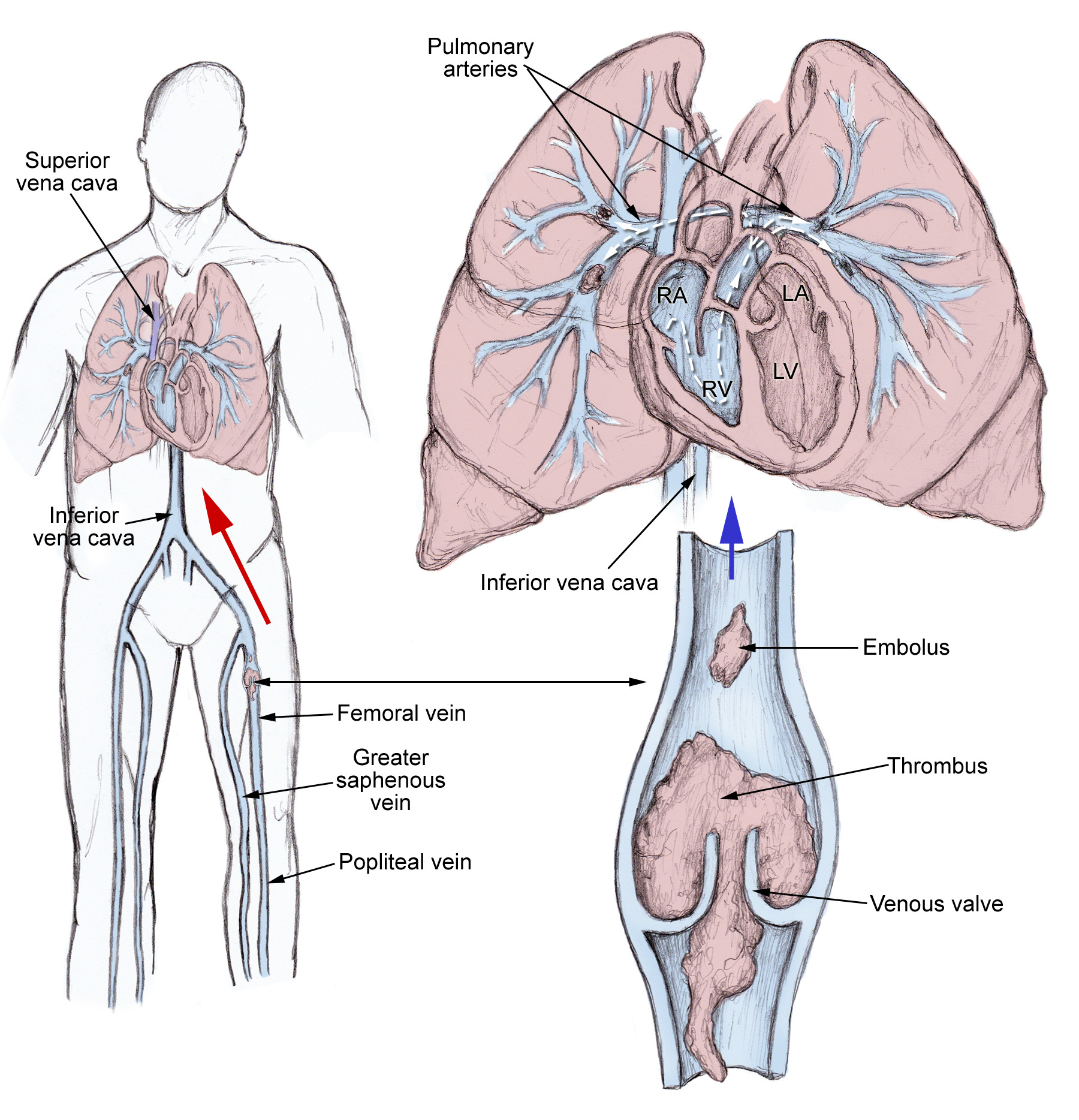 pulmonary embolism بالتفصيل 756148-756734-759765-1529103