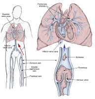 pulmonary embolism بالتفصيل 756148-756734-759765-1529103tn