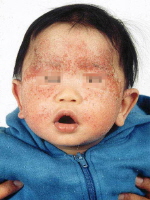 Atopic Dermatitis in Emergency Medicine 756148-762044-762045-1710113tn