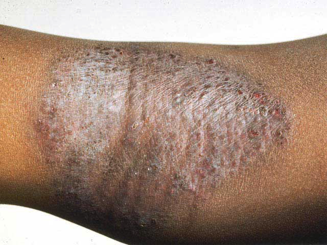 Atopic Dermatitis in Emergency Medicine 756148-762044-762045-1710116