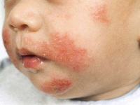 Atopic Dermatitis in Emergency Medicine 756148-762044-762045-1710117tn