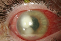 Contact Lens Complications 1189694-1193217-1196459-1638616tn