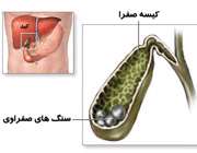 چگونه بفهمیم بیماری کیسه صفرا داریم؟ 1317020023017411817116761722151481056788254