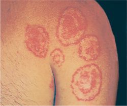 tinea corporisفطريات جلدية 500221-fx9