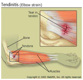 Lesiones: tendinitis. Arthritis_tendinitis_elbow_strain