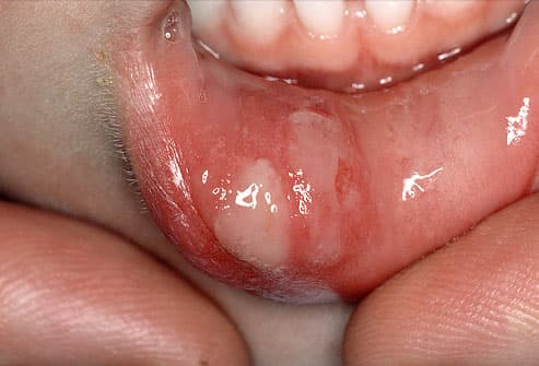 Top 15 Problems in Your Mouth Phototake_rm_photo_of_canker_sore