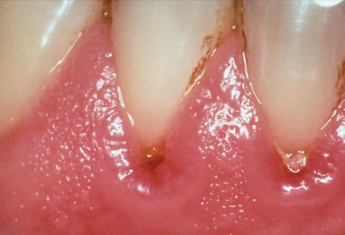 Top 15 Problems in Your Mouth Phototake_rm_photo_of_gingivitis