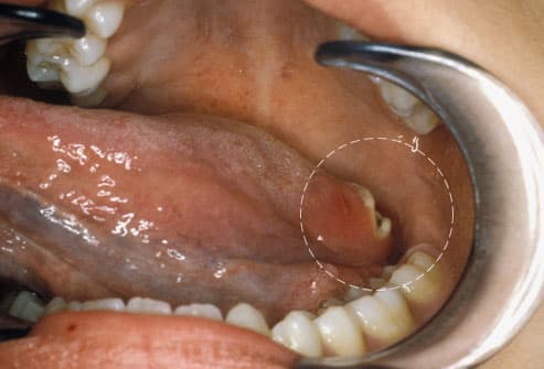 Top 15 Problems in Your Mouth Phototake_rm_photo_of_tongue_cancer