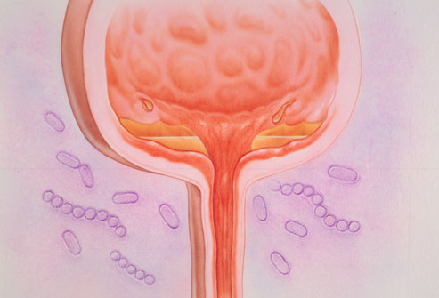 خطوات بسيطه للحفاظ على صحة المثانه البوليه  Phototake_rm_photo_of_interstitial_cystitis