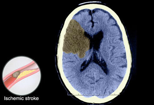 علاج الجلطة الدماغية Princ_rm_photo_of_ct_scan_showing_ischemic_stroke