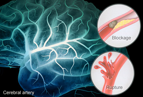 علاج الجلطة الدماغية Webmd_rm_illustration_of_stroke_causes_