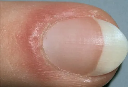  أسرار قد تكشف من خلال النظر إلى أظافرك Mh_photo_of_red_puffy_nail_fold