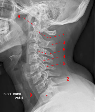 Rennes - Rachis  Rachis-cervical-profil_fs-1faa5ac