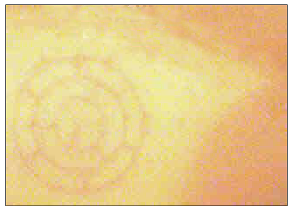 Étranges traces circulaires cutanées.  Signe-31-414a55f