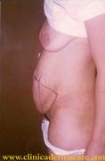 ABDOMINOPLASTIA, MODELADO DEL ABDOMEN. Th_35966_abdom1_122_492lo