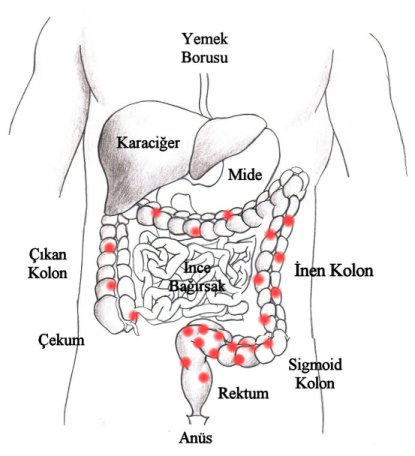 Kolon (Barsak) ve Mide Kanseri Nedir? Polip_sag2