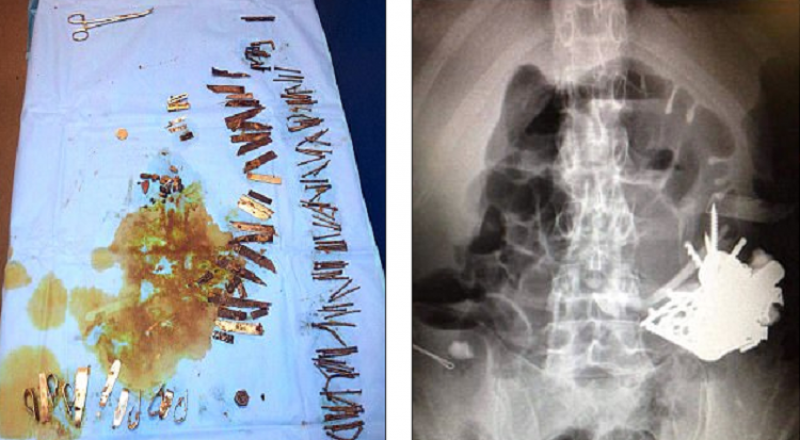 لا يصدّق .. استخراج 100 قطعة معدنية من معدة مريض نفسي! Bb059d60248d437501d5a8b4567