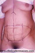 ABDOMINOPLASTIA, MODELADO DEL ABDOMEN. Th_23023_abdominopre_122_63lo