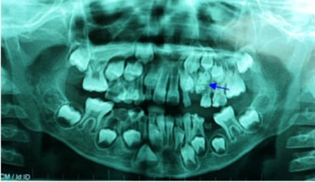 7-year-old boy with 76 teeth  20121004164831_1