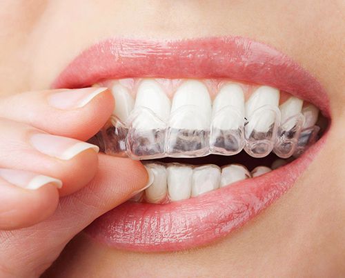 Niềng răng không mắc cài invisalign giá bao nhiêu tiền? Nieng-rang-khong-mac-cai-invisalign-gia-bao-nhieu-tien-4