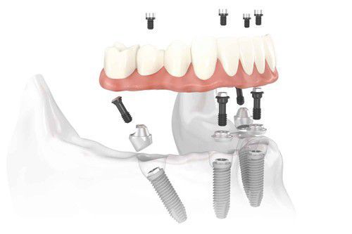 Implant cấy ghép cho những trường hợp nào? Implant-cay-ghep-cho-nhung-truong-hop-nao-1