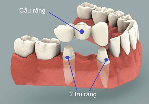 Implant cấy ghép cho những trường hợp nào? Implant-cay-ghep-cho-nhung-truong-hop-nao-2