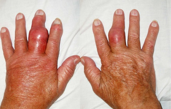 Bệnh Gout: Một dạng nguy hiểm của viêm khớp 2708-benh-gout