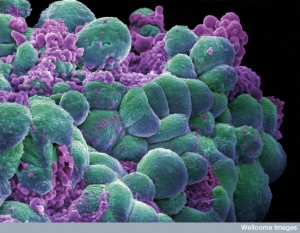 The Remarkable Language of Cells WC-breast-cancer--300x233