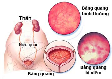  Hai bệnh phái mạnh nguy hại nhưng thường bị mắc hiện tại Viem-bang-quang-cystitis