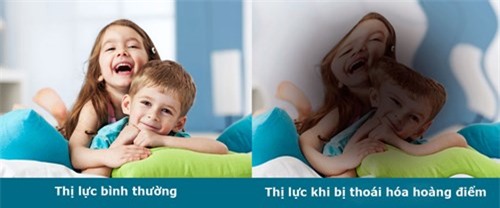 Các dấu hiệu làm mù lòa phổ biến tại Việt Nam Bo-qua-trieu-chung-benh-mat--duong-tat-dan-den-mu-loa_1