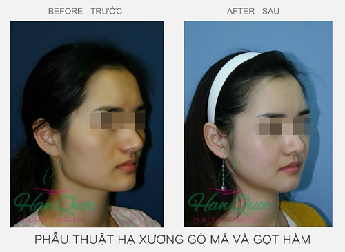 Xem hình ảnh phẫu thuật khuôn mặt V Line Hinh_anh_phau_thuat_khuon_mat_v_line_6