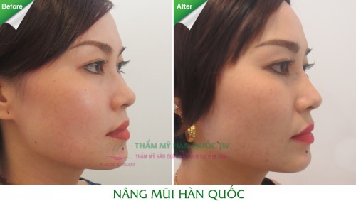 Chi phí nâng mũi bọc sụn Hàn Quốc bao nhiêu tiền? Nang-mui-han-quoc-e1441339159467