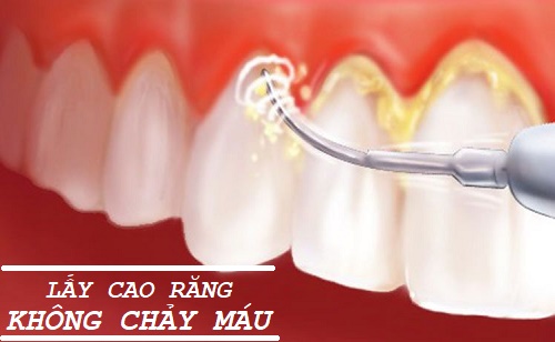 Giải đáp: Lấy cao răng không chảy máu với phương pháp siêu âm hiệu quả Lay-cao-rang-khong-chay-mau1