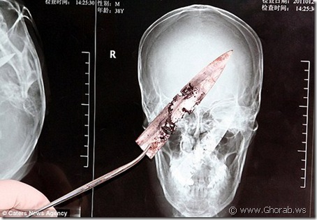 سبحان الله المنجى من المهالك Chinese-man-with-a-knife-in-skull-01%5B12%5D