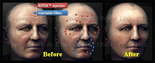 ما هى مادة البوتوكس وما هى فوائدهاواضرارها؟ Botox-and-fillers