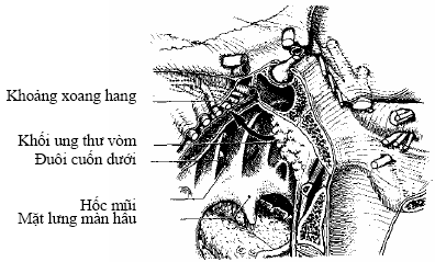 UNG THƯ VÒM MŨI HỌNG  B17.ht4